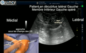 IPACK sous echographie
